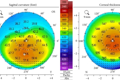 Dwie mapy topografii rogówki z kolorowymi skalami. Analiza topografii rogówki cena może być kluczowa dla wyboru metody leczenia.