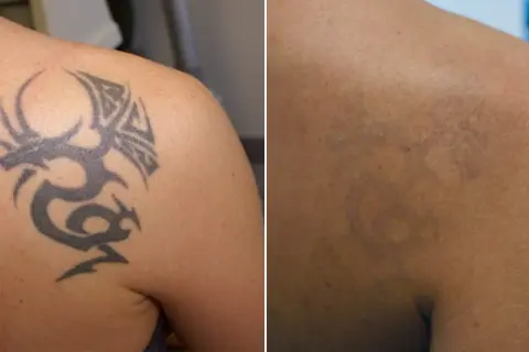 Przed i po zabiegu laserem pikosekundowym: widoczny tatuaż smoka na ramieniu, a po prawej jego wyraźne rozjaśnienie.