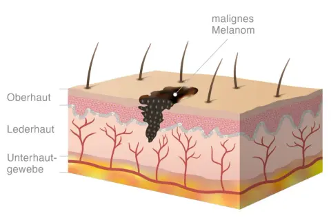 Querschnitt der Haut mit einem malignen Melanom, das sich in Oberhaut und Lederhaut ausbreitet. Haare und Blutgefäße sind sichtbar.