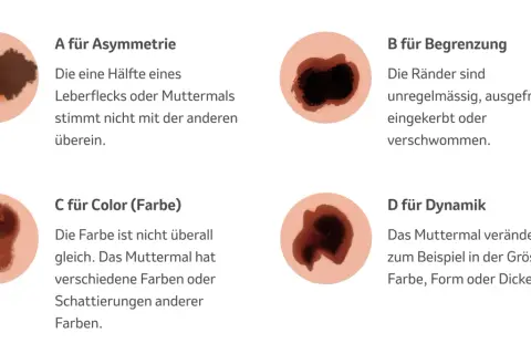 Hautveränderungen: Asymmetrie, unregelmässige Ränder, Farbwechsel und Dynamik sind Anzeichen für schwarzen Hautkrebs (Vorstufe).