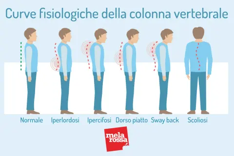 Illustrazione mostra posture della colonna vertebrale: normale, iperlordosi, ipercifosi, dorso piatto, sway back e scoliosi. La scoliosi sinistro-convessa può causare invalidità.