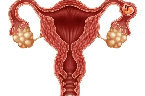 Ciąża pozamaciczna: Objawy, diagnostyka, leczenie. Co musisz wiedzieć?