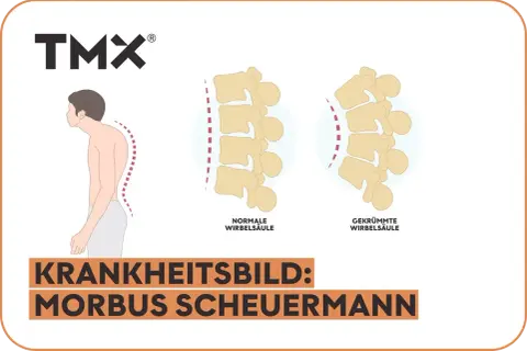 Vergleich einer normalen und gekrümmten Wirbelsäule, die das Krankheitsbild Morbus Scheuermann im Endstadium illustriert.