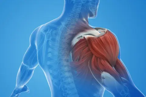 Contractura muscular: Identifica el "nudo" y dile adiós al dolor.