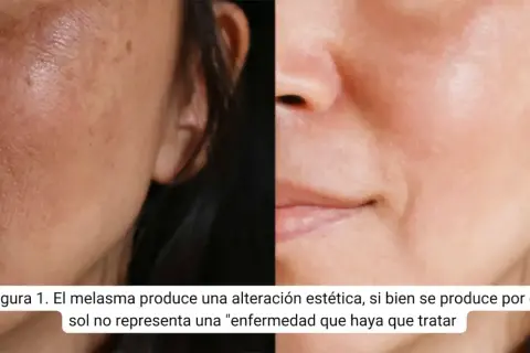 Comparativa de piel con melasma y piel tratada. Buscando amchafibrin para manchas opiniones, se observa mejora.