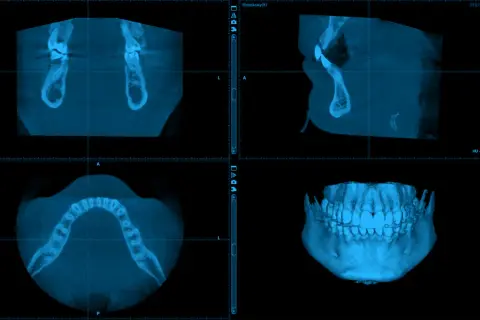 CBCT co to? Obraz pokazuje trójwymiarowe skanowanie szczęki i żuchwy, ukazując zęby i kości w przekrojach.
