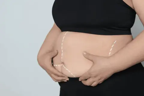 Osoba z zaznaczonym brzuchem, przygotowująca się do zabiegu. Dowiedz się, jak zakwalifikować się do operacji bariatrycznej na NFZ.