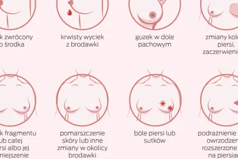 Ilustracja pokazuje objawy, które mogą wskazywać na nowotwór złośliwy sutka: zmiany brodawki, guzek, obrzęk, zaczerwienienie, ból.