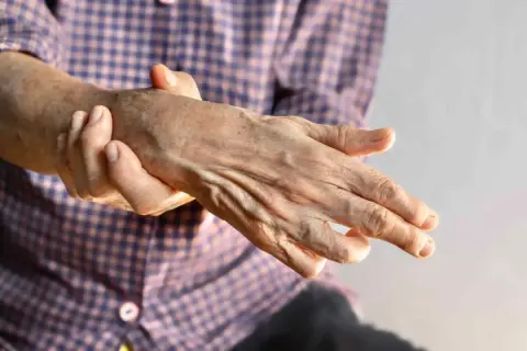 Mano anziana con dita piegate, che ricorda una mano ad artiglio, con la pelle segnata dal tempo.