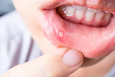 Nahaufnahme einer Lippe mit einem weißen, wunden Fleck. Ein Finger berührt die betroffene Stelle, die auf wunden im mund hausmittel hinweist.