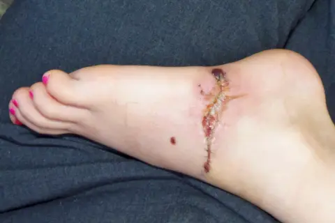 Stopa z raną pooperacyjną, która zaczyna wykazywać objawy gangreny. Widoczne są ciemne, martwicze tkanki i zaczerwienienie.