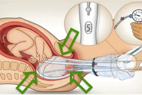 Illustration d'un bébé dans l'utérus, avec une ventouse d'accouchement appliquée sur sa tête. Un manomètre indique la pression.