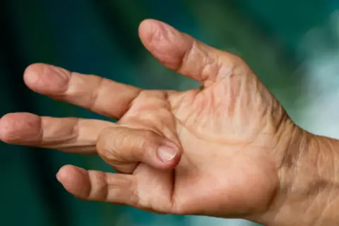 Nahaufnahme einer Hand, bei der ein Finger in einer gekrümmten Position verharrt. Dies kann ein Symptom für einen Schnappfinger sein, dessen Ursache oft eine Entzündung der Sehnenscheide ist.