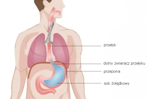 Nerwica przełyku objawy: Jak rozpoznać niepokojące symptomy?