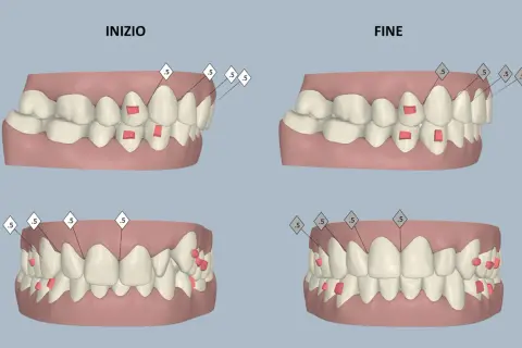 Confronto tra denti prima e dopo il trattamento ortodontico, con evidenziati gli attachment Invisalign.