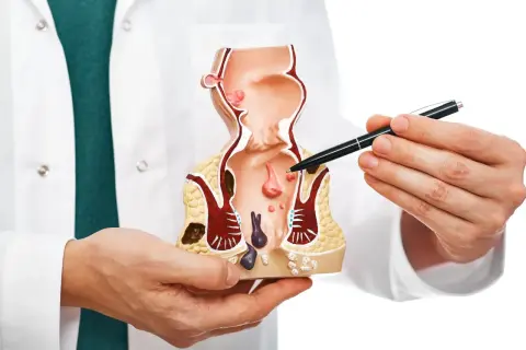 Lekarz od odbytu pokazuje na modelu anatomicznym zmiany chorobowe.