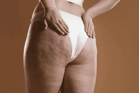 Dettaglio della coscia e del gluteo con cellulite, un'immagine che stimola la riflessione su come eliminare la cellulite e migliorare la propria pelle.