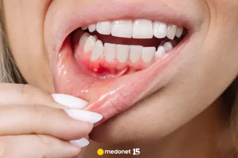 Ból dziąseł? Szybka ulga w domu i kiedy do dentysty!