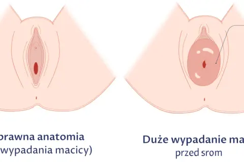 Obniżona macica po porodzie: 7 objawów, które musisz znać