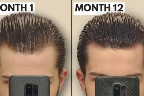 Comparaison avant/après 12 mois : le derma roller a visiblement densifié la chevelure et réduit la perte de cheveux sur le front.