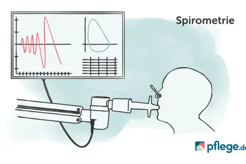 Spirometrie-Diagramm zeigt Lungenfunktion. Bei COPD Gold 3 ist der GdB oft hoch.