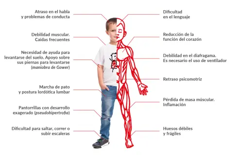 Un niño muestra los efectos de la distrofia muscular de Duchenne: debilidad muscular, problemas de lenguaje, cardíacos y respiratorios, entre otros.