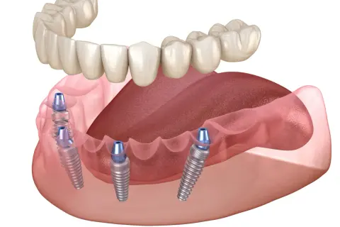 Górna proteza zębowa opiera się na implantach wszczepionych w dolną szczękę.