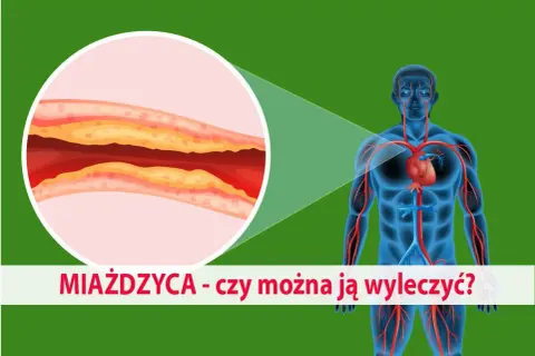 Zbliżenie na zatkaną miażdżycą tętnicę obok sylwetki człowieka z widocznym układem krwionośnym.