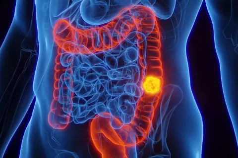 Darmkrebs-Tumor im menschlichen Darm, der eine wichtige Rolle bei der Erhaltungstherapie spielt.