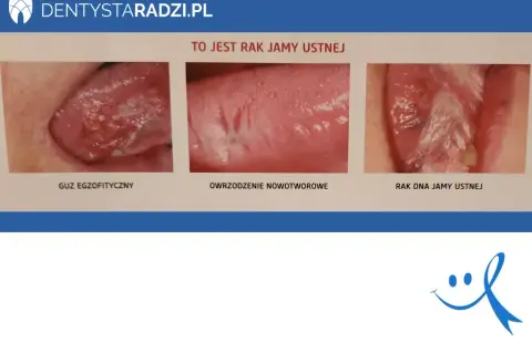 Objawy nowotworu jamy ustnej: Wczesne sygnały ratujące życie