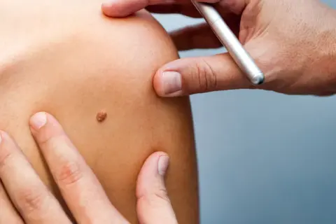 Un médecin examine un grain de beauté qui saigne sur l'épaule d'un patient.