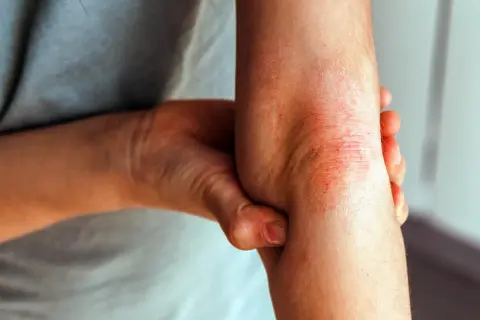 Armbeuge mit geröteter, schuppiger Haut, die stark juckt, typisch für Neurodermitis.