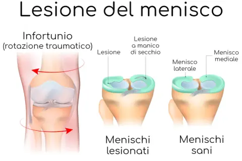 Illustrazione di un ginocchio con menisco lesionato a causa di un infortunio da rotazione. Confronto tra menischi sani e lesionati.