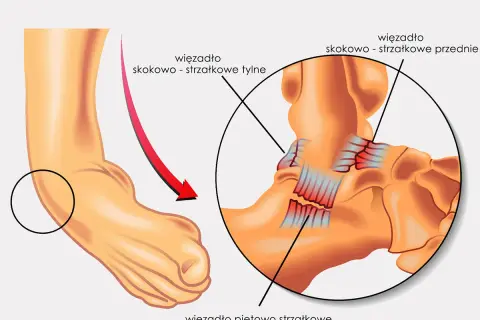 Ilustracja anatomiczna stawu skokowego z zaznaczonymi więzadłami i strzałką wskazującą skręt.