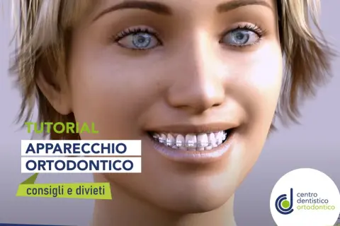Tutorial apparecchio ortodontico: scopri se si possono mangiare le patatine con l'apparecchio e altri consigli utili.