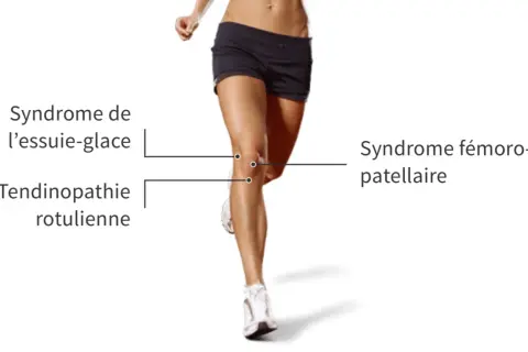 Jambes d'une coureuse, illustrant le syndrome de l'essuie-glace et la tendinopathie rotulienne, causant une douleur au genou externe.