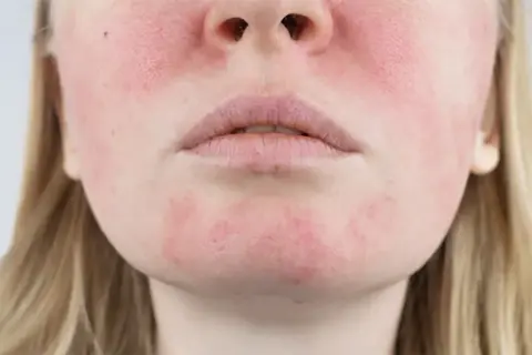 Primo piano del viso di una donna con pelle irritata e arrossata sulle guance e sul mento.