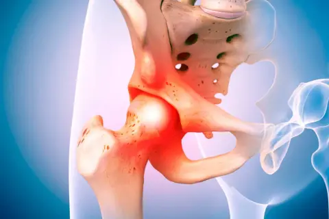Anatomical illustration of a hip joint with inflamed areas indicating bolące biodra.