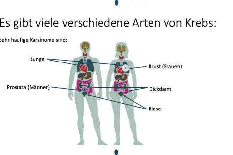Abbildung zeigt, welche Krebsarten es gibt: Lunge, Prostata, Brust, Dickdarm und Blase sind häufige Karzinome.
