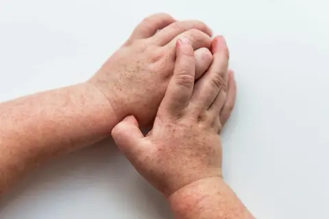 Dłonie z wysypką, która może być jednym z objawów HIV. Czerwone plamki na skórze.