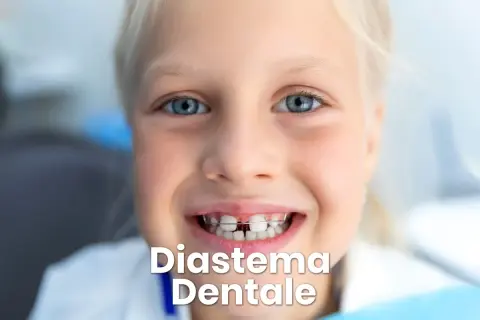 Bambina sorridente con apparecchio ortodontico che corregge lo spazio tra i denti.
