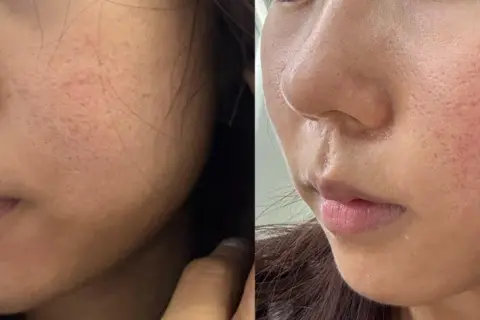 Split image showing a woman's cheek and nose area before and after fractional laser treatment, highlighting changes in skin texture and pore appearance.