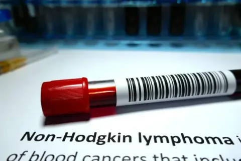 Blutprobe mit Barcode für die Diagnose von Non-Hodgkin-Lymphom.