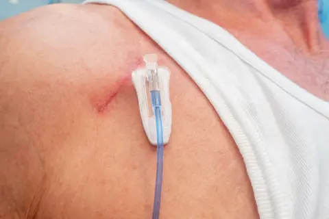 Port-a-Cath für Chemotherapie: Ein Blick auf die Haut mit dem Zugangssystem.