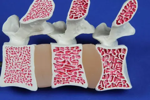 Model kręgosłupa z widoczną gąbczastą strukturą kości. Czy osteopenia może się cofnąć? Tak, przy odpowiednim leczeniu i stylu życia.