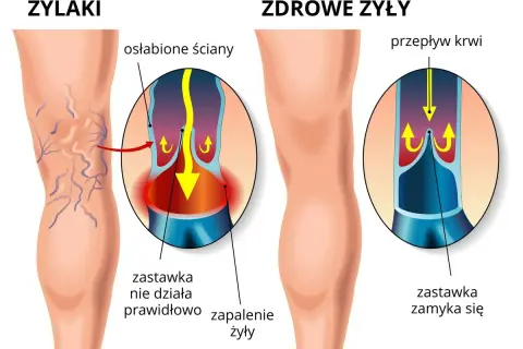 Ilustracja pokazuje nogę z widocznymi żylakami, porównując ją ze zdrową żyłą. Pokazuje, jak osłabione ściany i wadliwe zastawki prowadzą do zapalenia żył.