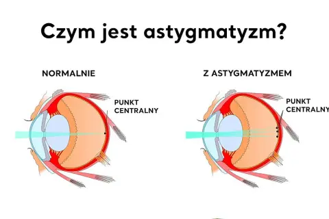 Astygmatyzm: Objawy, przyczyny i skuteczne metody korekcji