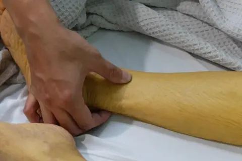 Żółta skóra nogi, wskazująca na podwyższony poziom bilirubiny w moczu.