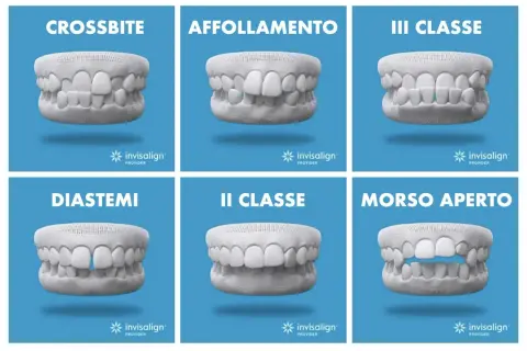 Sei casi di malocclusione dentale: crossbite, affollamento, III classe, diastemi, II classe, morso aperto. Soluzioni con mascherine invisalign.