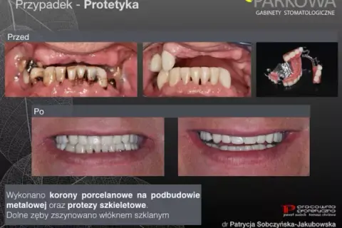 Szynowanie zębów: Na jak długo? Od urazu po paradontozę